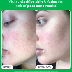 10% Azelaic Acid Booster 30ML
