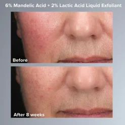 6% Mandelic Acid + 2% Lactic Acid Liquid Exfoliant 88ML