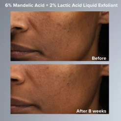 6% Mandelic Acid + 2% Lactic Acid Liquid Exfoliant 88ML