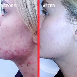 Acne Light Shot