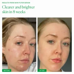 Alpha Beta Peel Extra Strength Formula