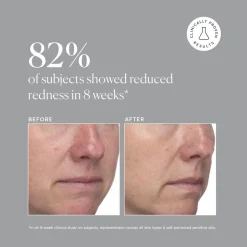 Azelaic Acid 10% 30ML