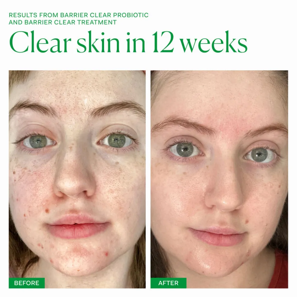 Barrier Clear Treatment 30ML