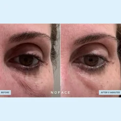 IonPlex® Hydra-Gel Power Patches