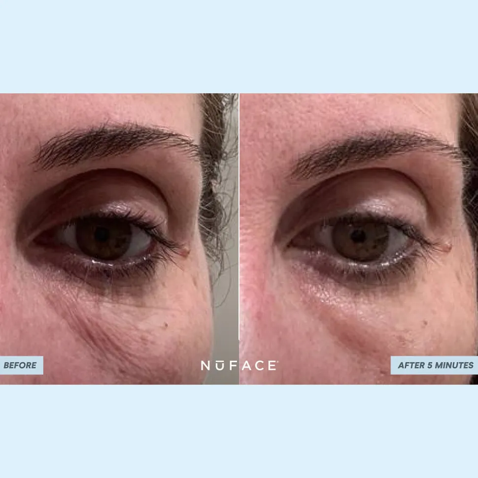 IonPlex® Hydra-Gel Power Patches