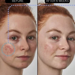 SuperSolutions 10% Azelaic Acid Serum 30ML