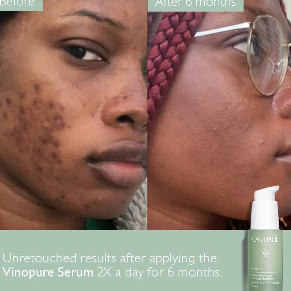 Vinopure Blemish Serum 30ML