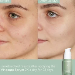 Vinopure Blemish Serum 30ML